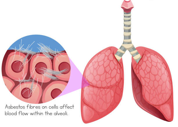 Asbestos Fibres on Cells Within Lungs illustration Asbestos Effects